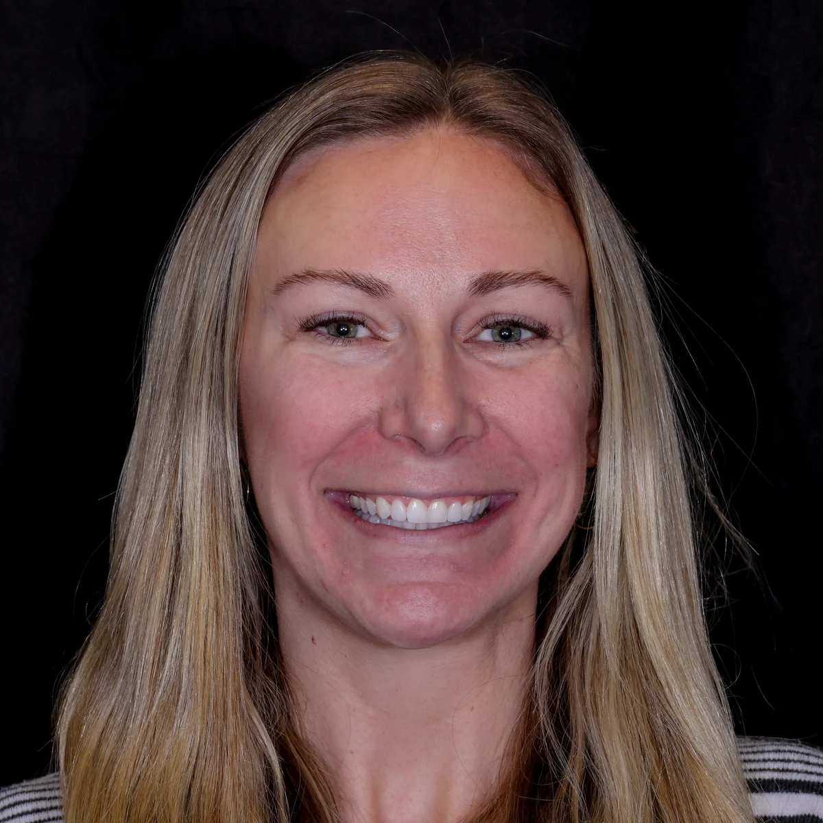 Before — Brandi — Smile Transformation