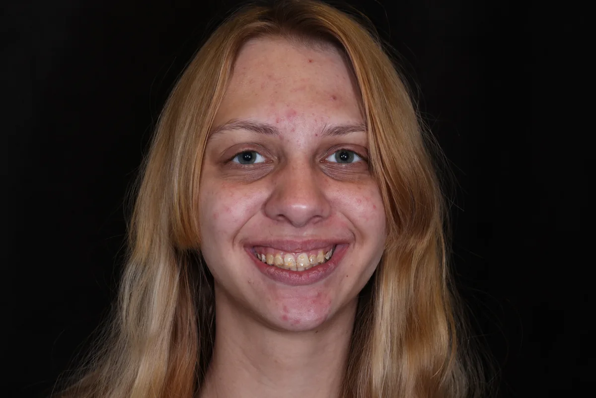 Before — Freya — Cosmetic Restoration
