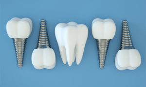 dental implant